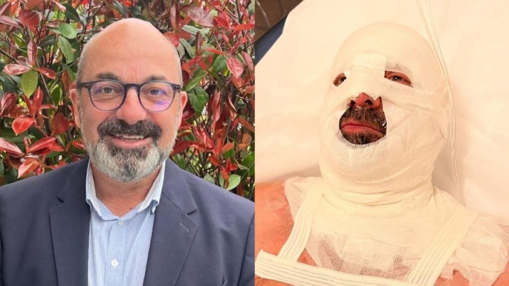 Alcalde en Francia se quemó el rostro al intentar encender una caldera que llevaba semanas apagada