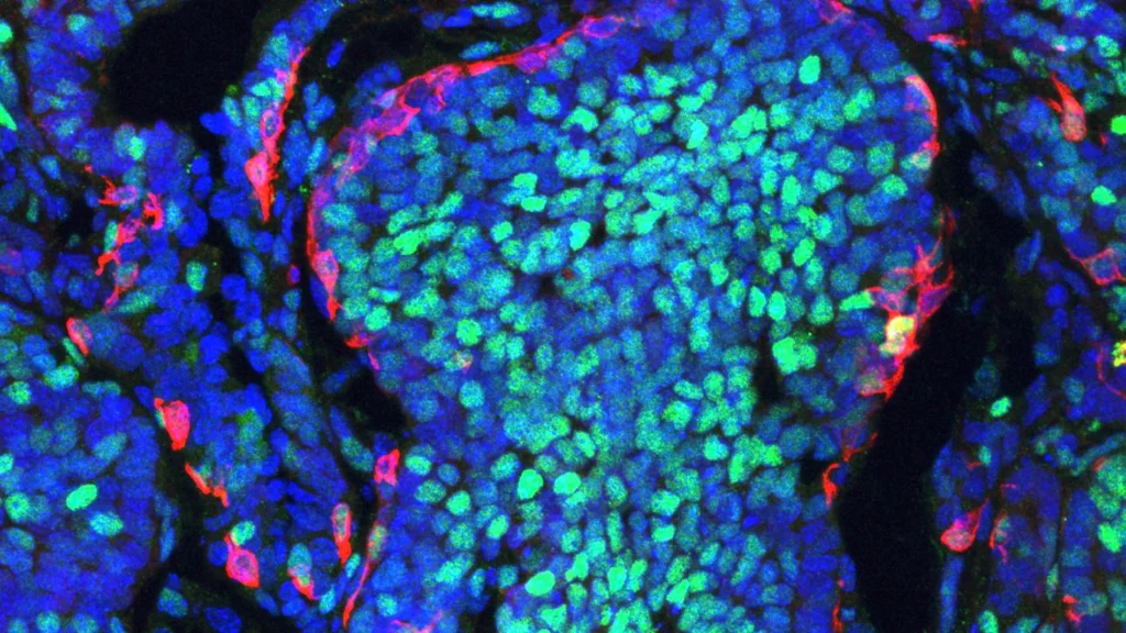 Científicos descubren 'cráteres' formados por células inmunitarias que atacan tumores cancerígenos