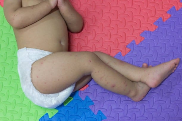 Las autoridades de salud de Norcasia suspenden actividades en dos sedes del hogar infantil tras el aumento de casos - crédito iStock